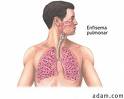 Se identifica un mecanismo responsable del enfisema pulmonar y la bronquitis crónica