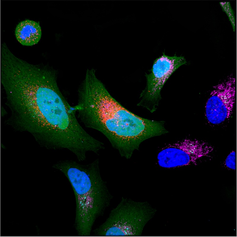 Cancer cell expressing microprotein (colored in red)